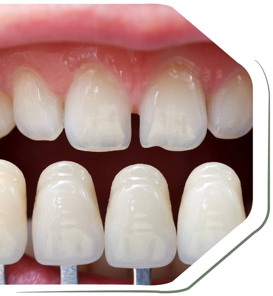 dental-veneers-for-teeth