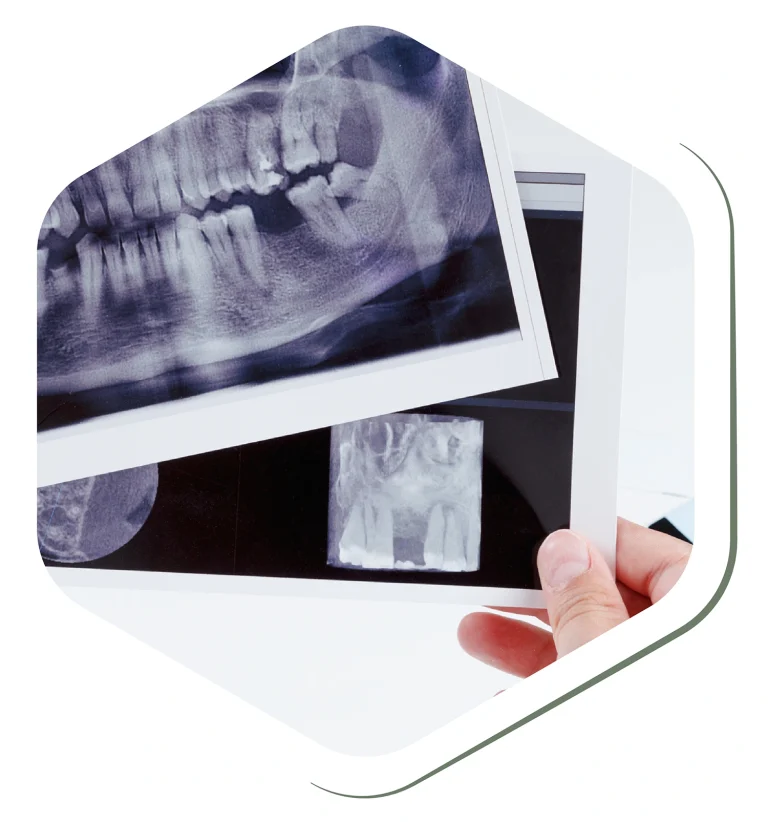 dental-x-ray-for-full-mouth-rehabilitation