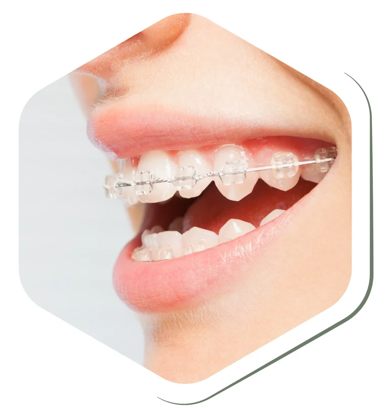 straighter teeth orthodontics