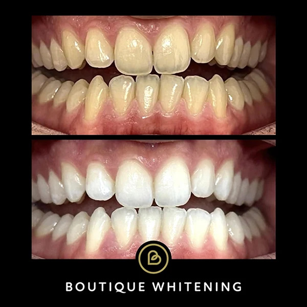teeth whitening before and after image