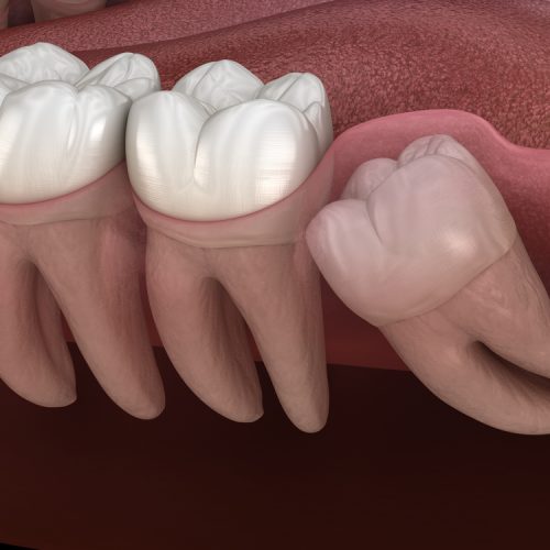 Wisdom tooth with impaction at molar tooth. Medically accurate tooth 3D illustration