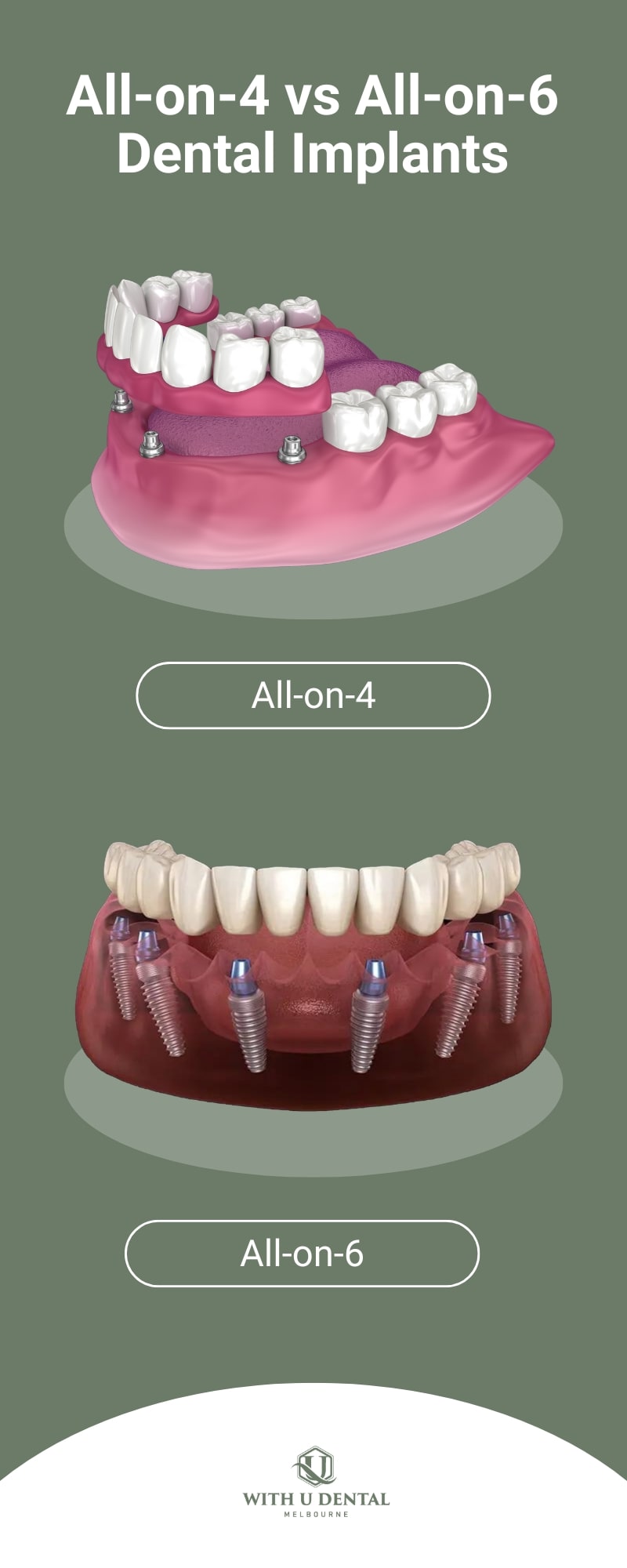 3d model of All-on-4 vs All-on-6 Dental Implants For Comparison
