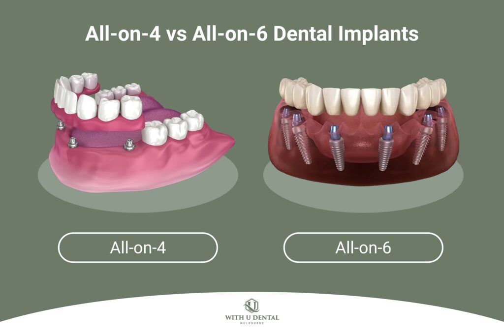 All-on-4 vs All-on-6 Dental Implants