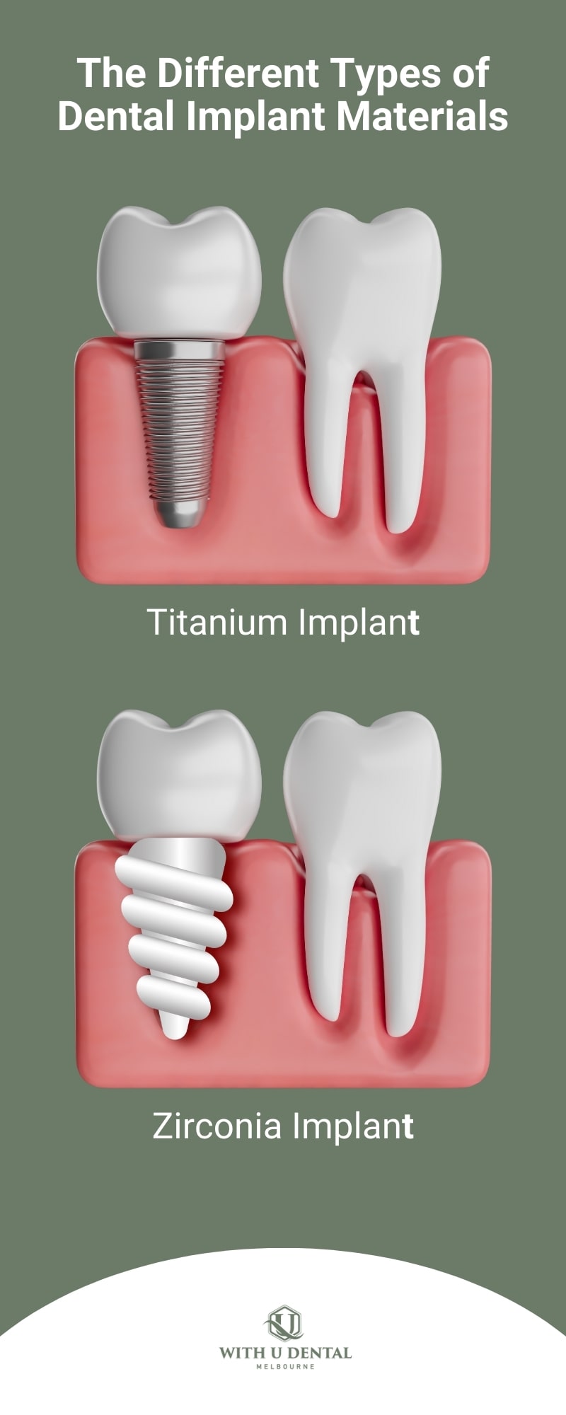 Dental Implant Materials Types
