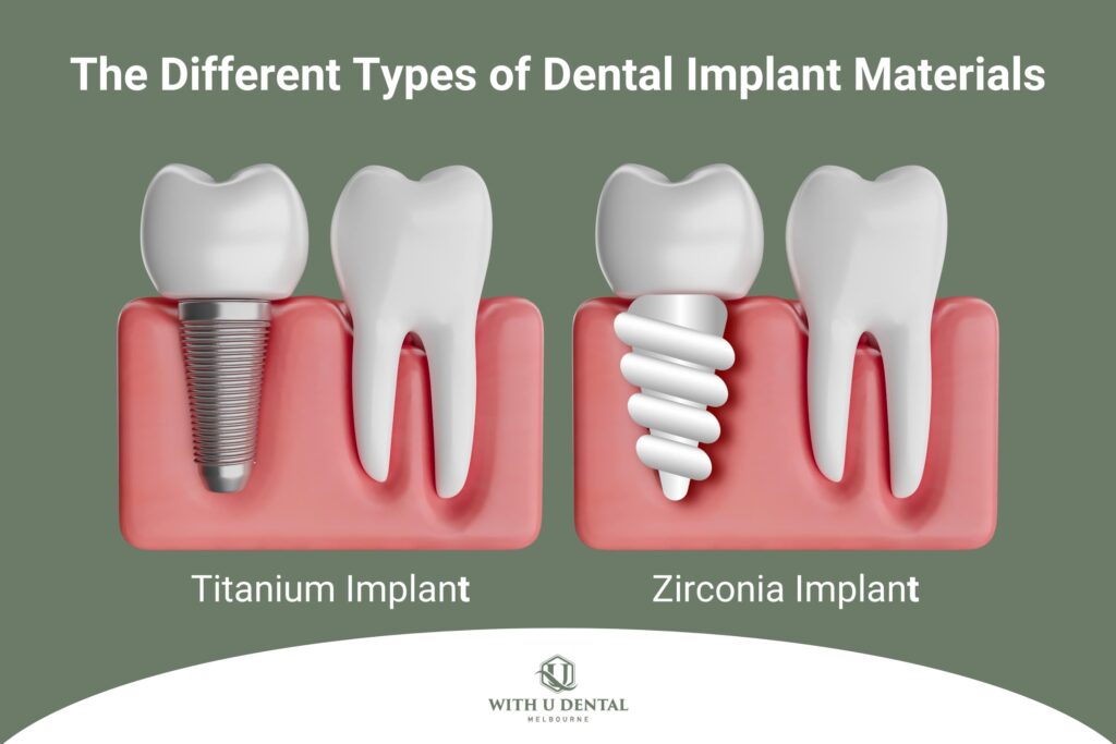 Different Types of Dental Implant Materials