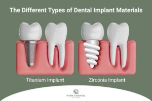 Different Types of Dental Implant Materials