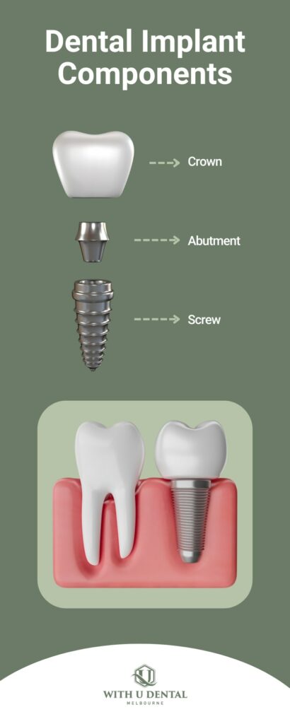 the dental implant components