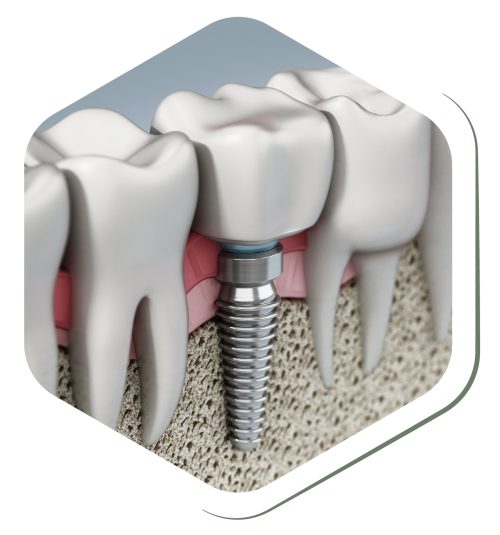 dental-implant-illustration-demographic-2-04